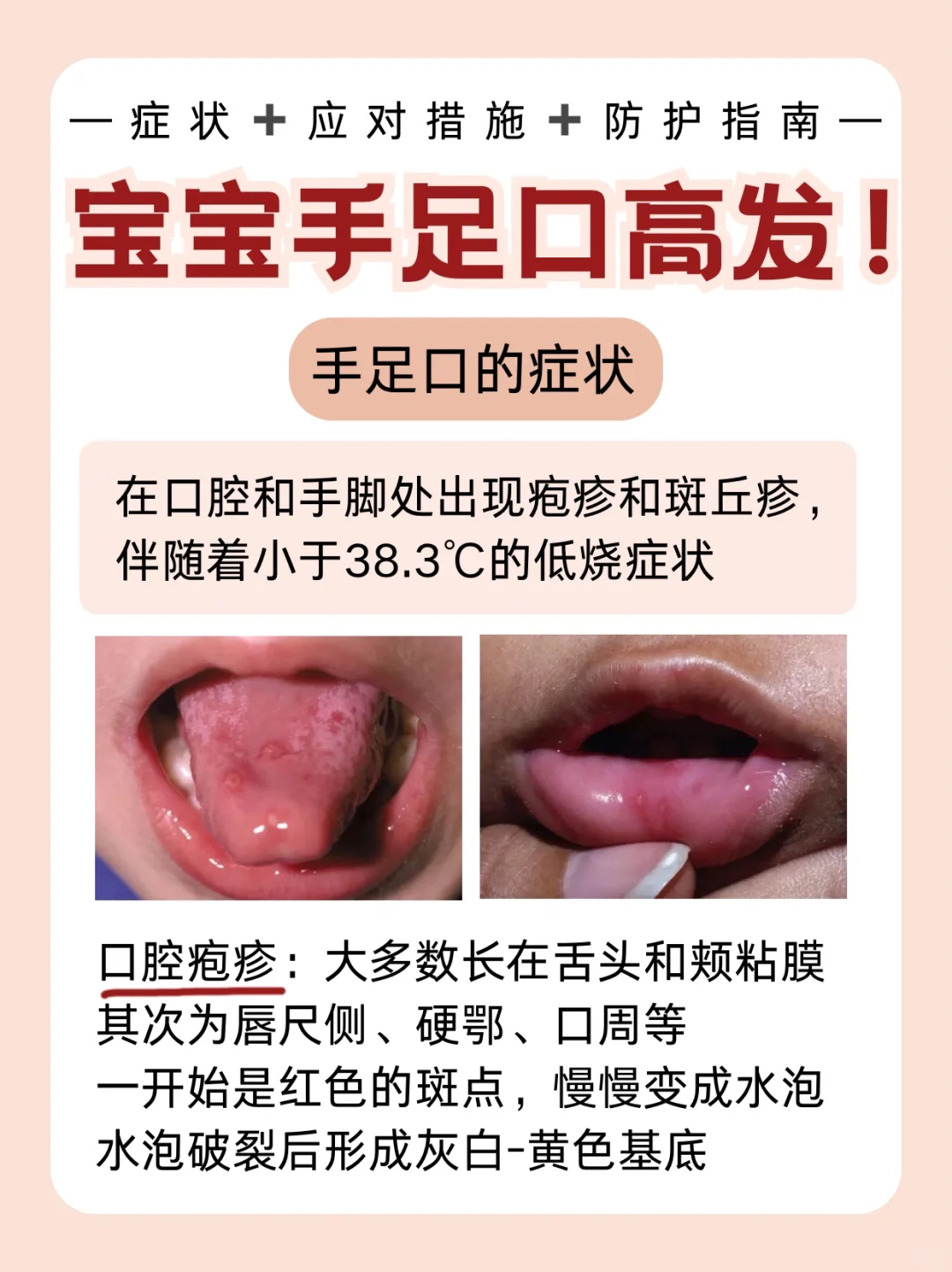 宝宝发烧高峰期！手足口症状+应对措施+防护