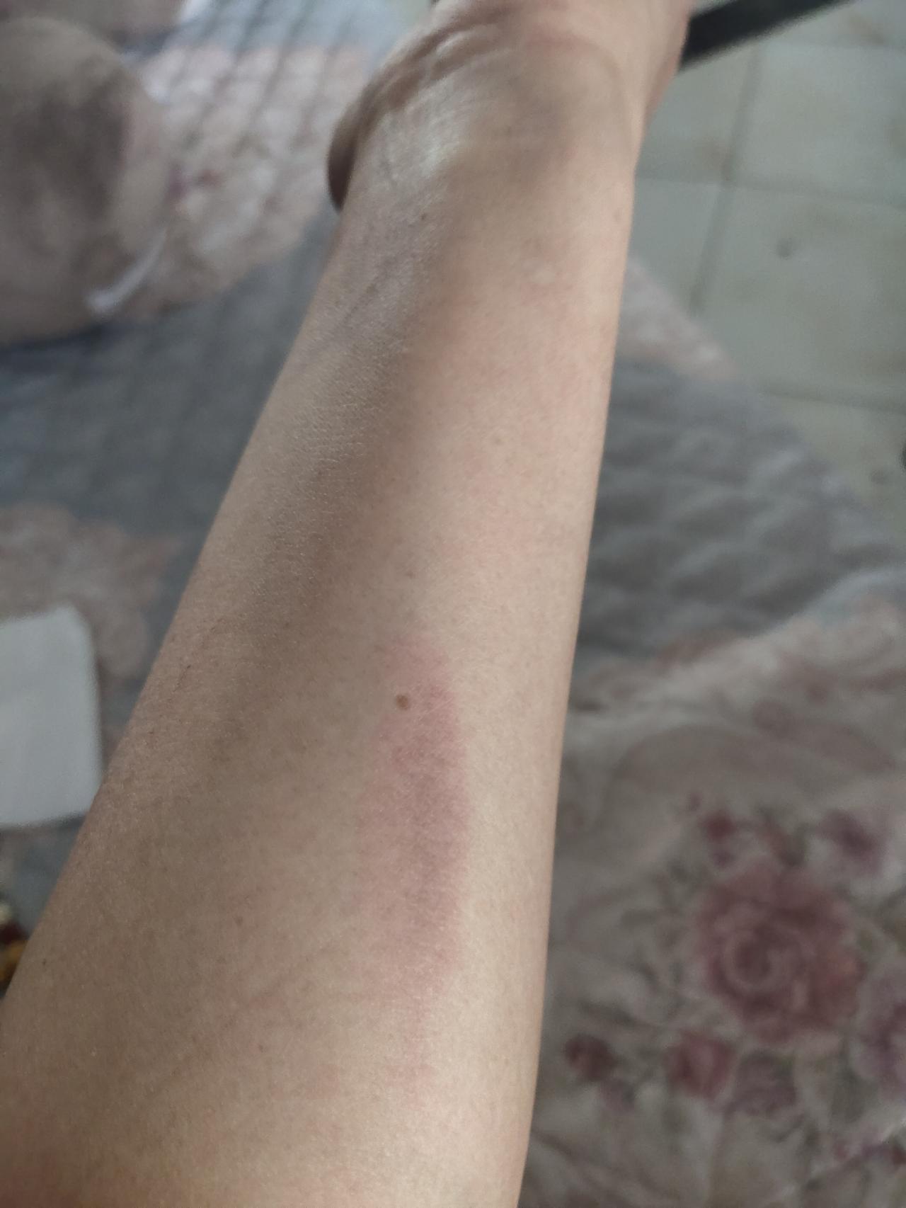 我做饭向来笨手笨脚的，不是被刀割一下，就是被锅或者热水烫一下，手和胳膊常常带着些