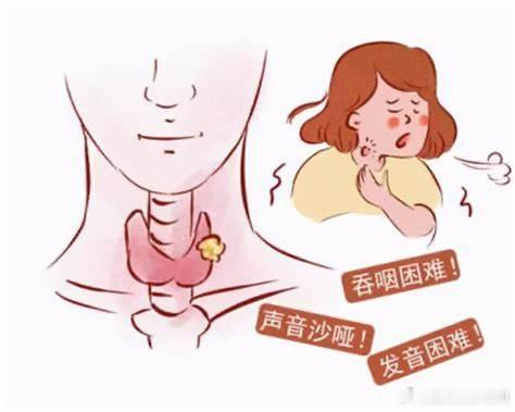  【甲状腺癌给出的6个信号】5、吞咽困难增大的肿瘤压迫食管，还可能出现吞咽困难。