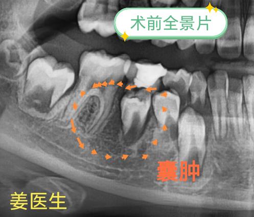 含牙囊肿。江苏的8岁小朋友，妈妈无意发现面部肿胀，检查发现含牙囊肿。上...