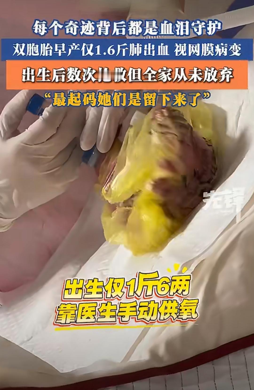 在贵州贵阳，有一对早产的双胞胎姐妹，出生的时候才6个多月，体重只有1.6斤，小得