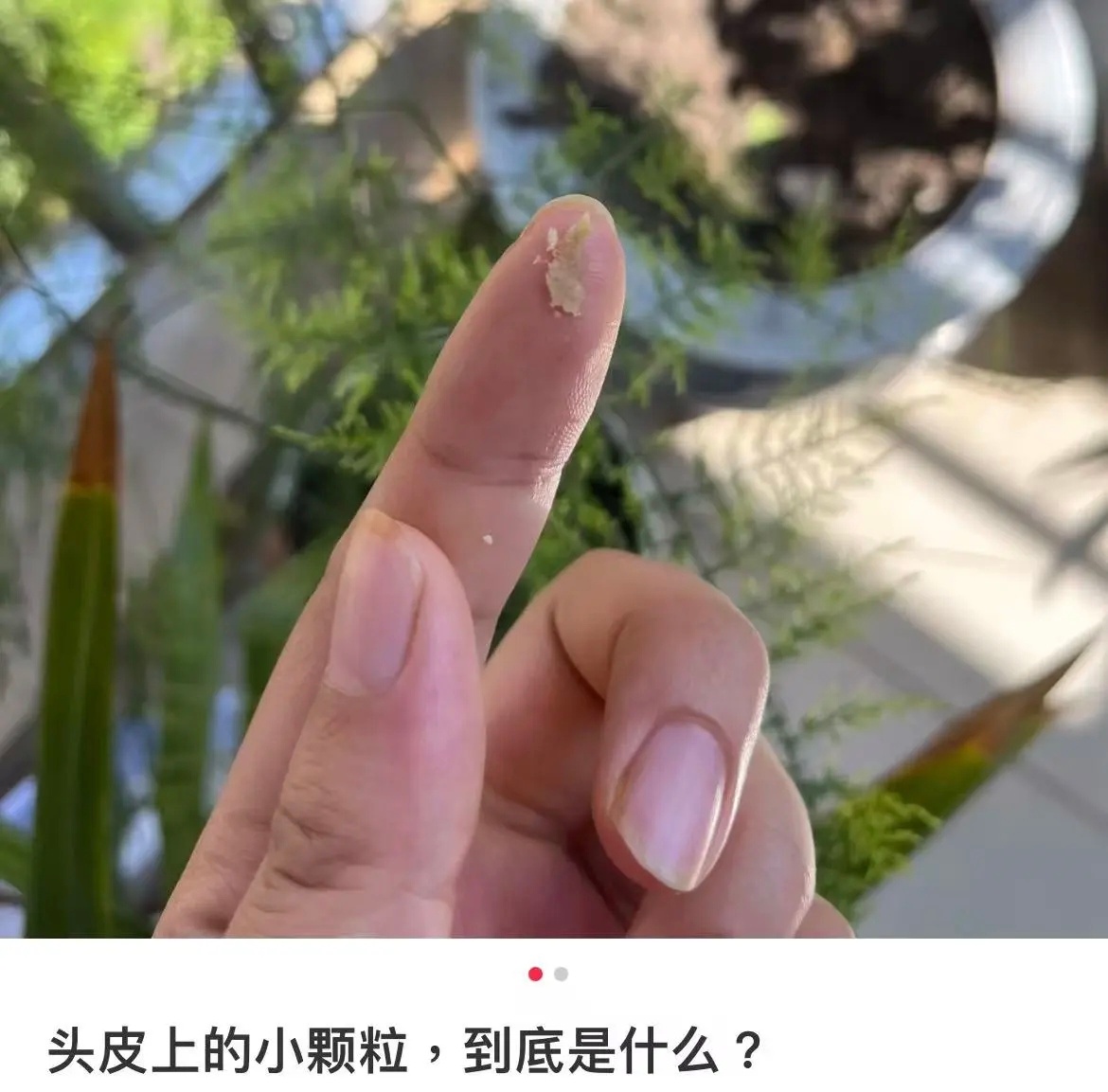 【头皮上抠出来的“白泥”到底是啥？】当你几天不洗头时，手指不经意间挠过头皮，指甲