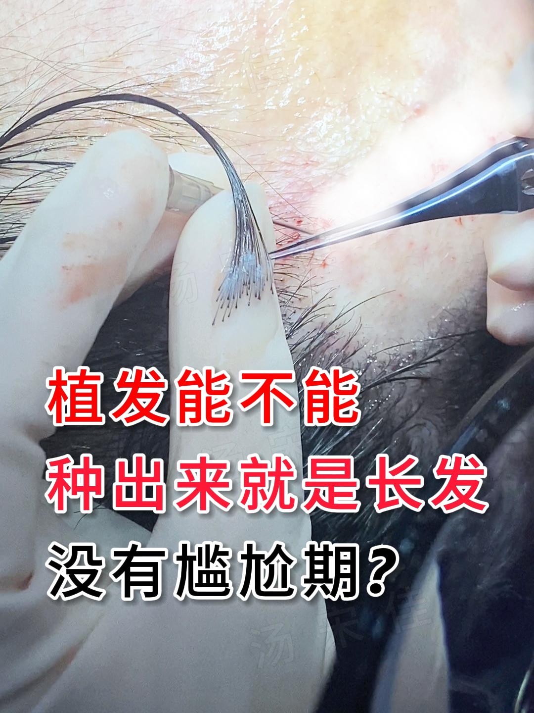植发能不能种出来就是长发，没有尴尬期？。很多人因为植发的尴尬期，放弃了植发。其实从技术角度来说，是可以的。不剃发长发植发，提取的是长的头发，种上去的也是长的头发，这样就能大大避免术后的尴尬期。为什么做不剃发长发植发的人很少呢？其实它也是有一定的局限性。1、收费比较高。长发植发是一般普通短发植发费用的2-3倍左右，这个费用对于很多人来说还是比较高的。2、长发植发的手术时间比较久。不适合大面积种植的人群，如果都采用长发进行提取和种植，手术时间可能要超过12个小时，这对于毛囊存活率是会有一定影响的。3、也会经历脱