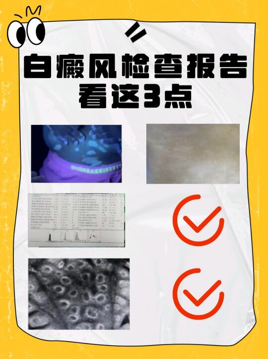 白斑什么时候好？⭕白癜风检查报告看这3点