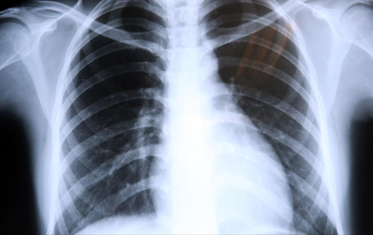 肺气肿和肺纤维化哪个更厉害，你知道两个病造成的后果就知道了
肺气肿是肺里气太多造