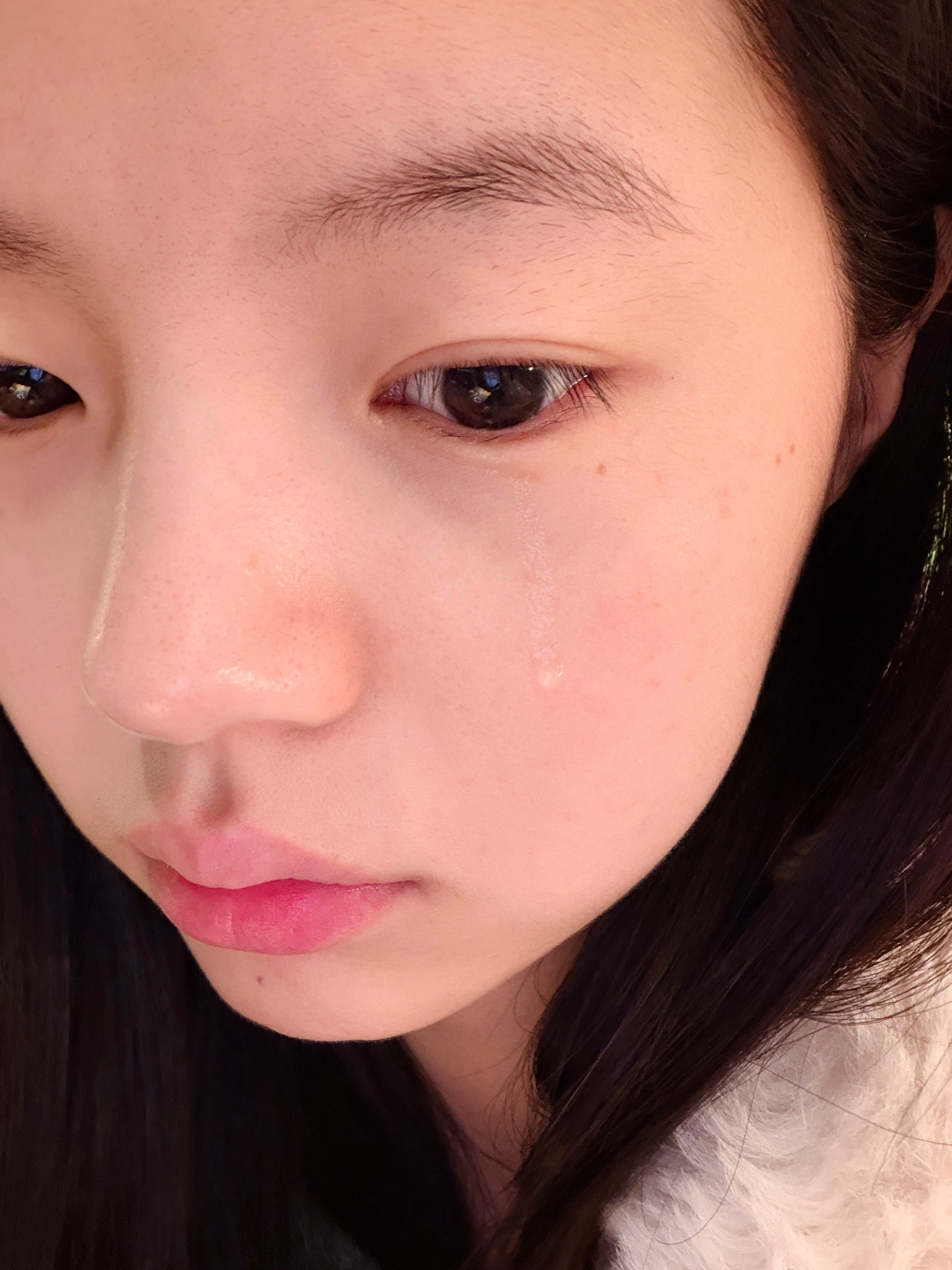 一到冬天右眼就犯病(沙眼症)