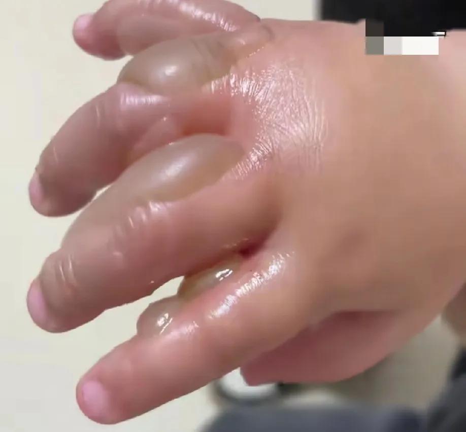张纪中才9个月的小女儿手被保姆给烫的满手都是大水泡，隔着屏幕看都觉得手好痛。
