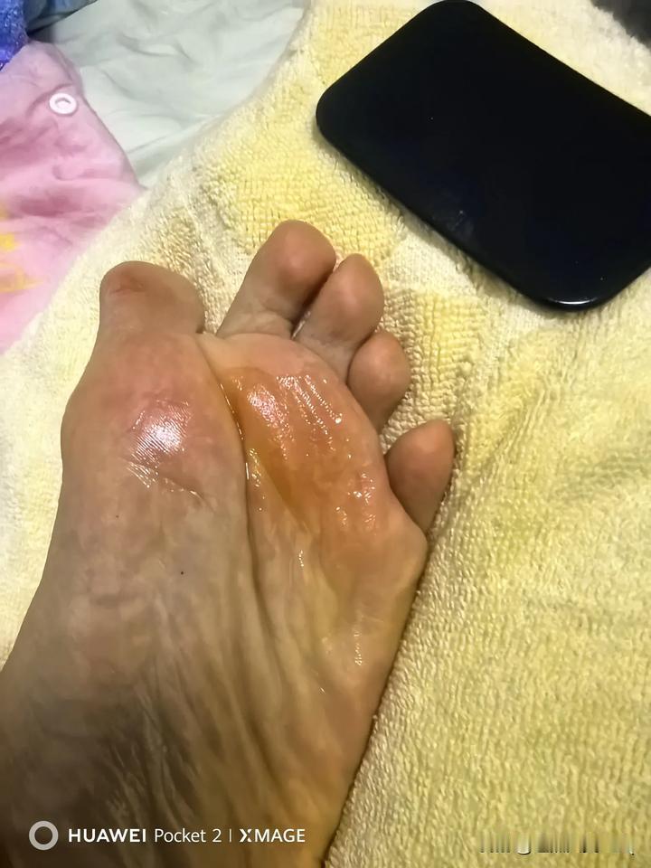 刮脚筋第五天，左脚的脚筋刮起来特别疼，还有一种疙疙瘩瘩的感觉，连带一种蹭蹭的声音