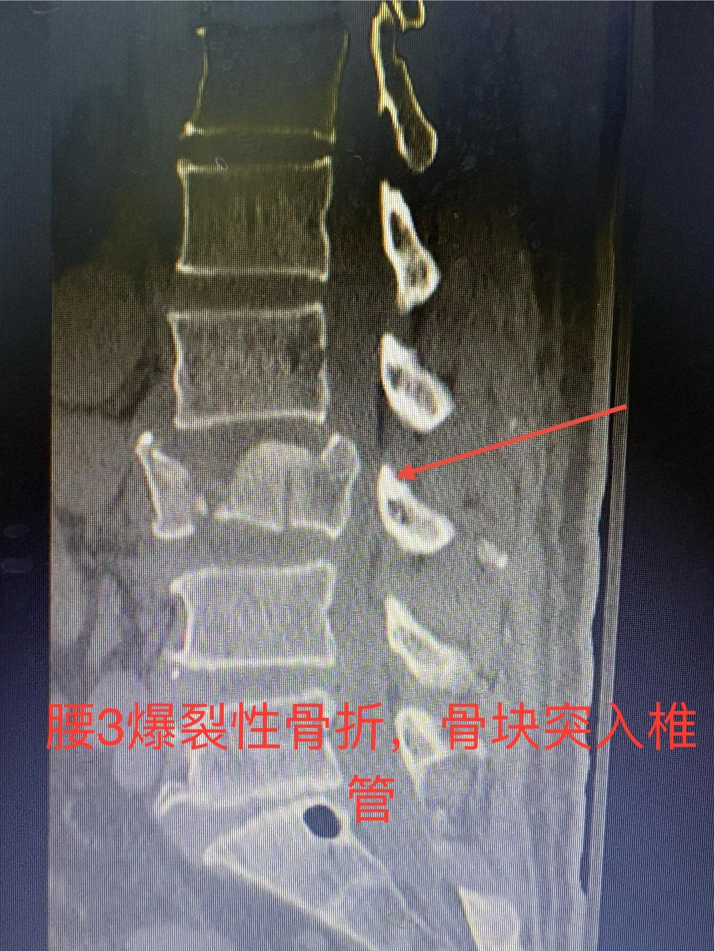 62岁外伤导致腰3爆裂性骨折，闭合复位，椎体复位稍差，但是椎管的复位还是满意