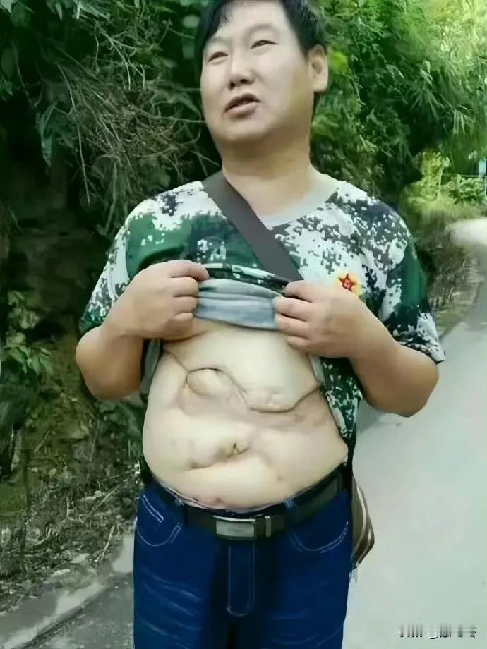 老山一等功臣雷毅，身上的伤疤成为了他特殊的勋章！致敬！#向英雄致敬#