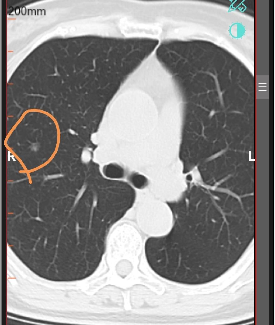 肺部结节长到多大才是恶性，才需要做手术呢？其实这不是一个很正确的认知，肺部结节到
