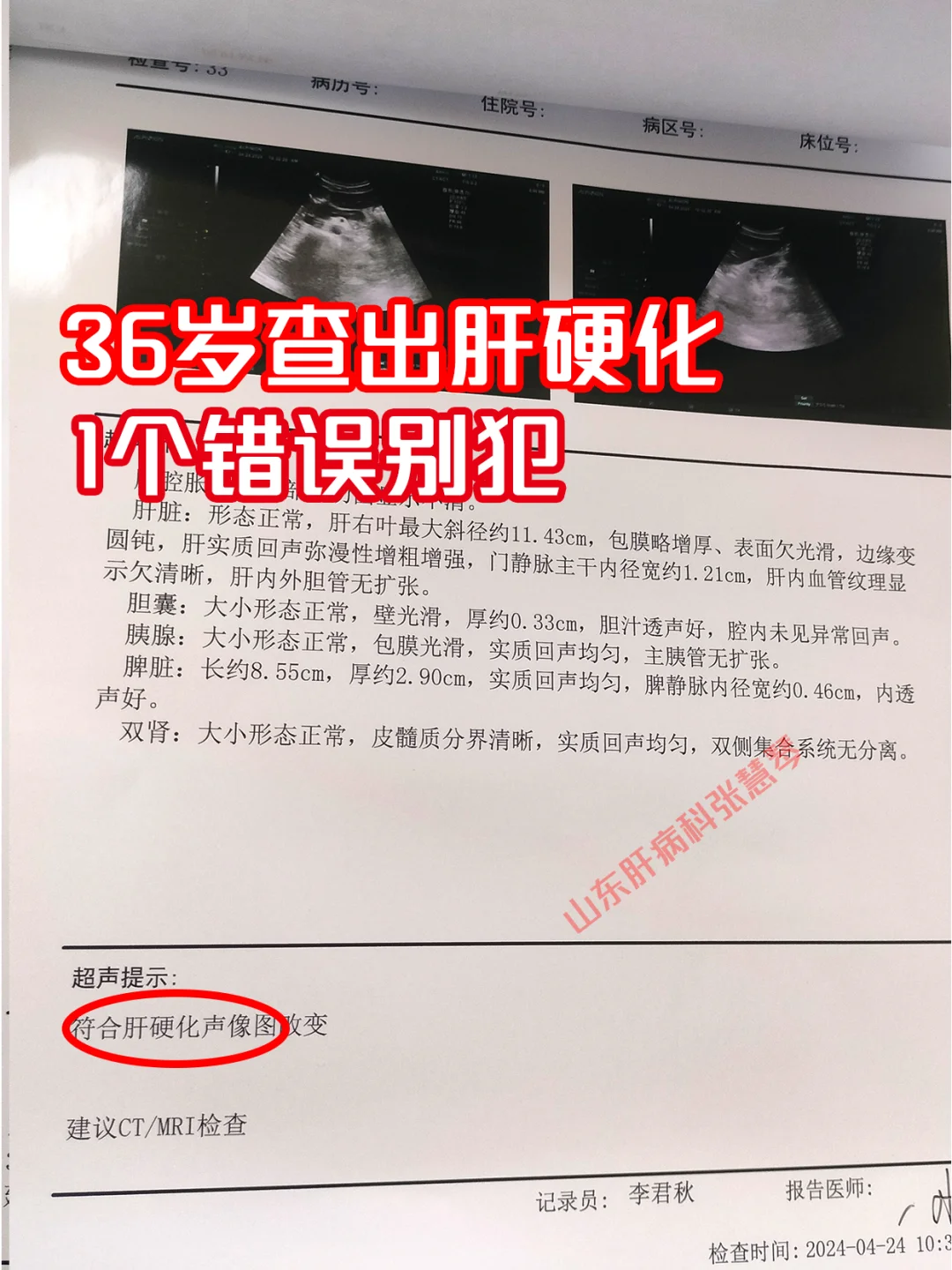 36岁查出肝硬化，只因忽视了这1点！