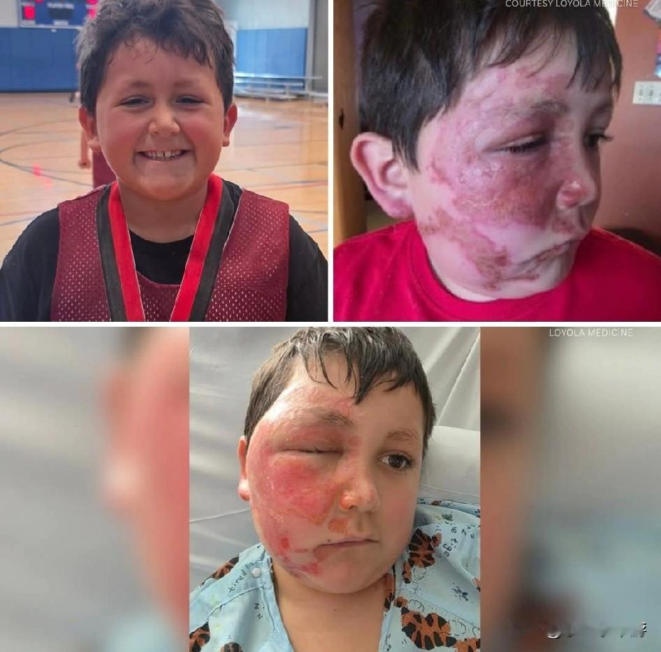 美国一名男童因将玩具放进微波炉加热，引发爆炸，造成脸部严重灼伤。家属和医院呼吁家