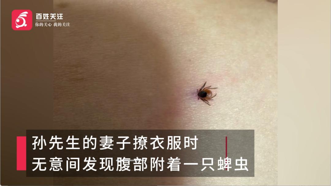 黑龙江哈尔滨，29岁女子和丈夫带着宠物狗去伊春游玩，返程时发现腹部叮着一只蜱虫，