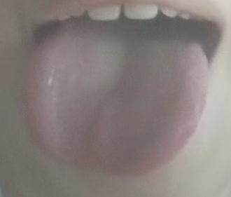 舌头一圈齿痕是阳虚信号！男士温阳补肾完整调理攻略







有位年轻男性患者