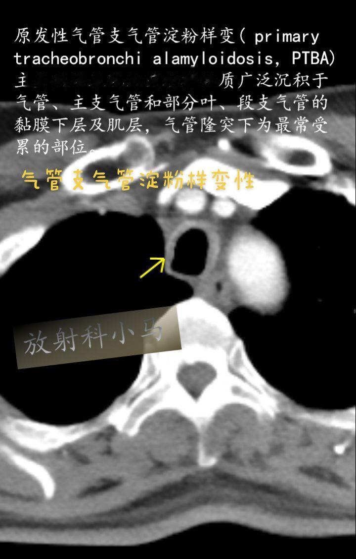 淀粉样变性是一组因折叠错误的蛋白质聚集成不溶性原纤维在细胞外沉积于不同...