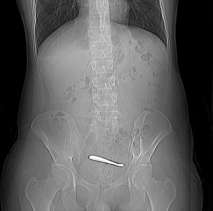 离谱！小伙腹痛CT查出肠道卡着两把勺子

南京一位28岁小伙因为腹痛去医院，一查