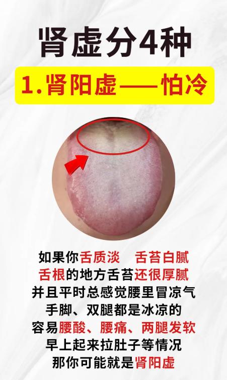 4 种肾虚舌象对照，你的舌头是哪一种？