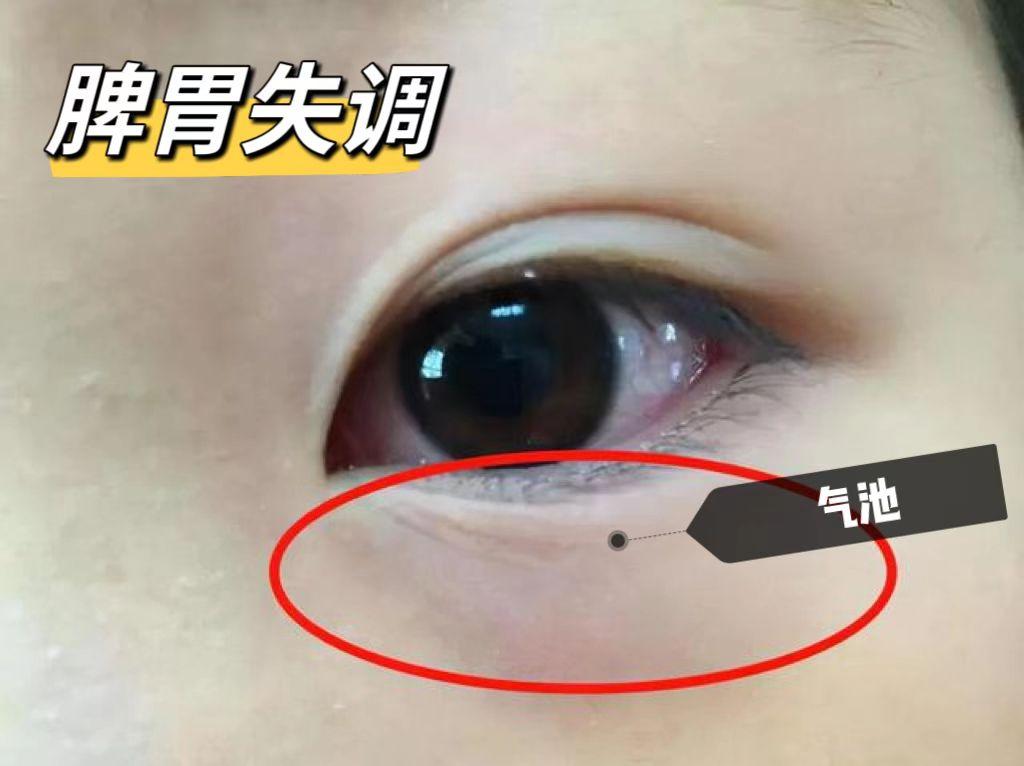 昨天面诊了这么一个孩子，一眼判断孩子脾虚，家长们可以关注一下！
 
乐乐（化名）