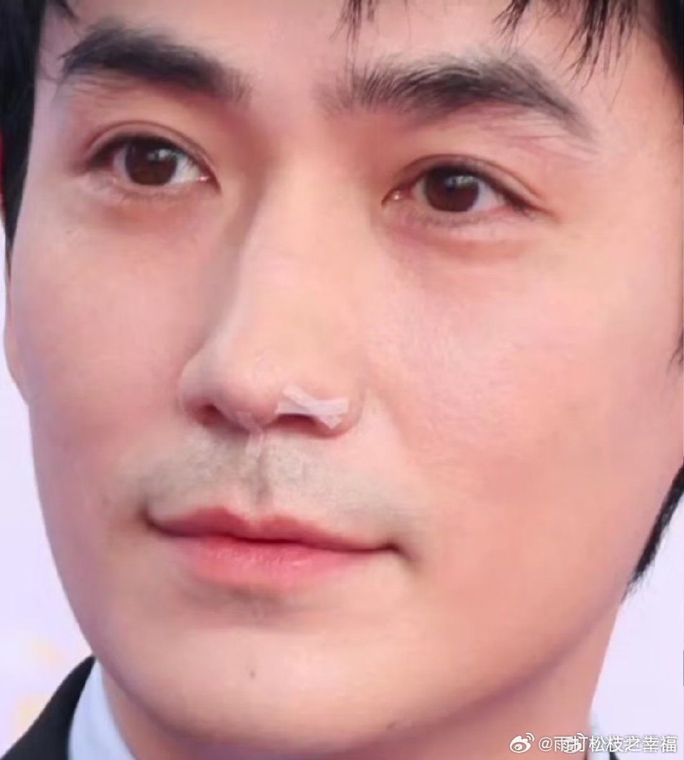 朱一龙鼻子怎么了朱一龙拍摄《千里江山图》动作戏时鼻子意外皮外伤，贴胶布是术后护理