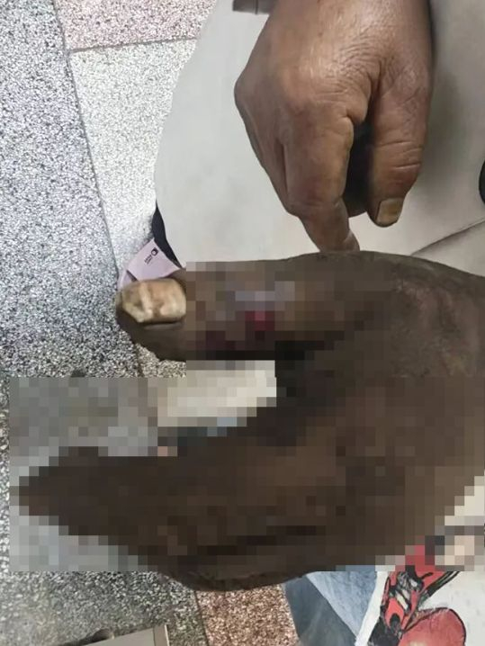 【大爷被蛇咬老伴用嘴吸蛇毒双双送医】近日，云南省红河哈尼族彝族自治州元阳县一大爷