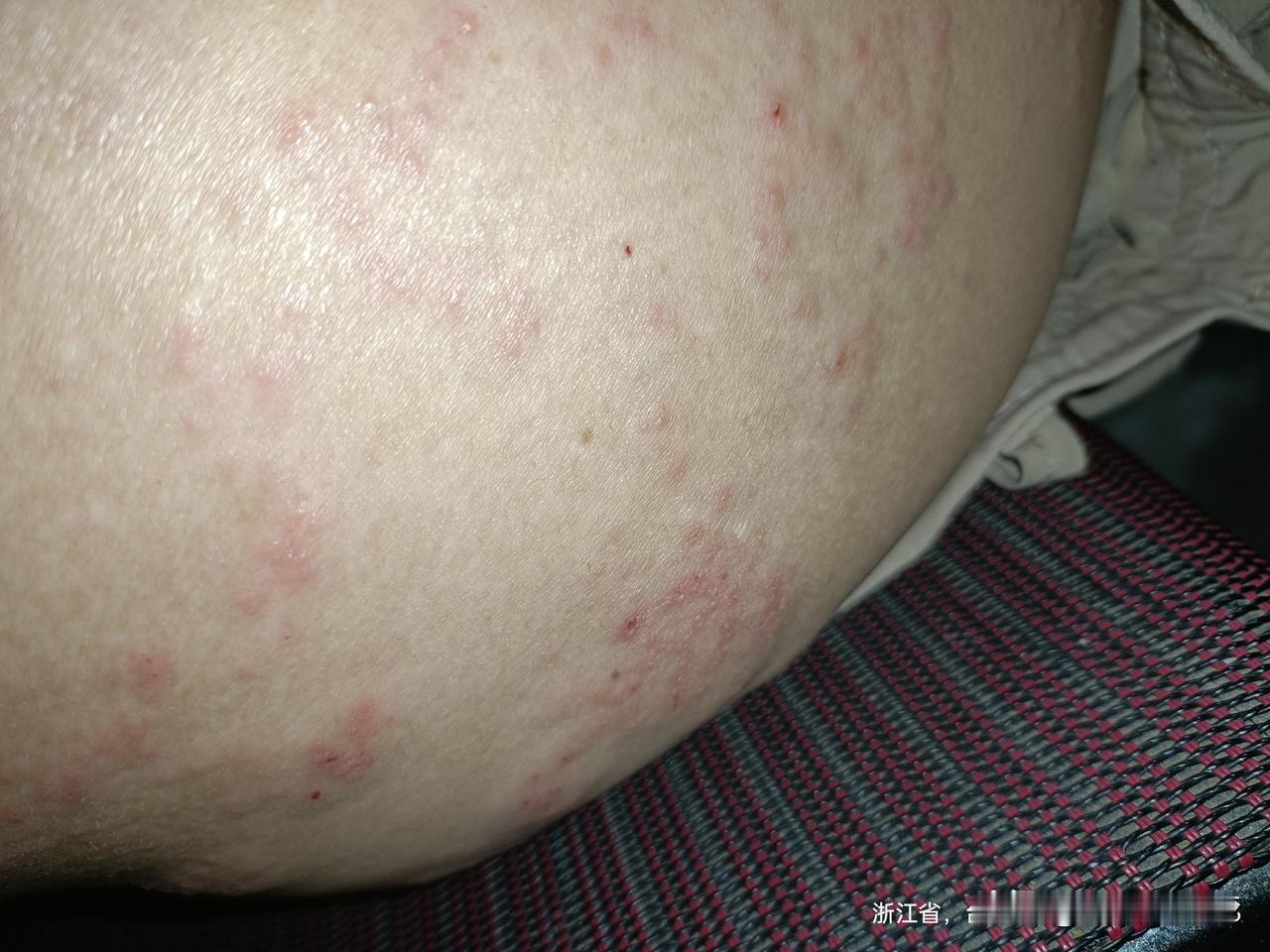 今天确认说带状疱疹，

今天去挂针，昨天还是水泡，今天痒起来，想抓，抓了又有痛，