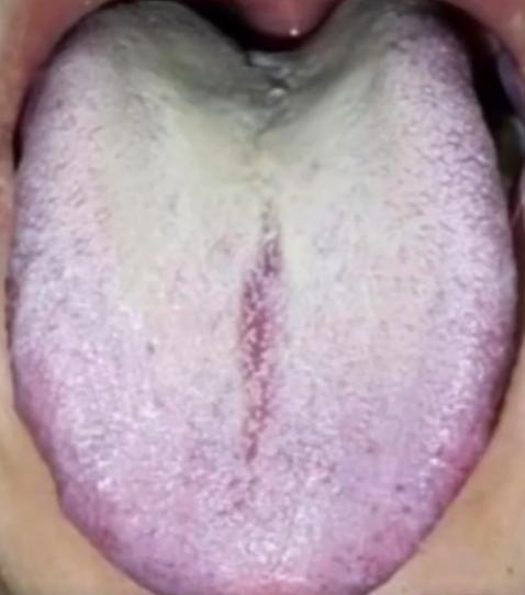 这种舌象别再只想着健脾了，除非你真的不想好了！

患者主诉：房事时间短，宗筋硬度