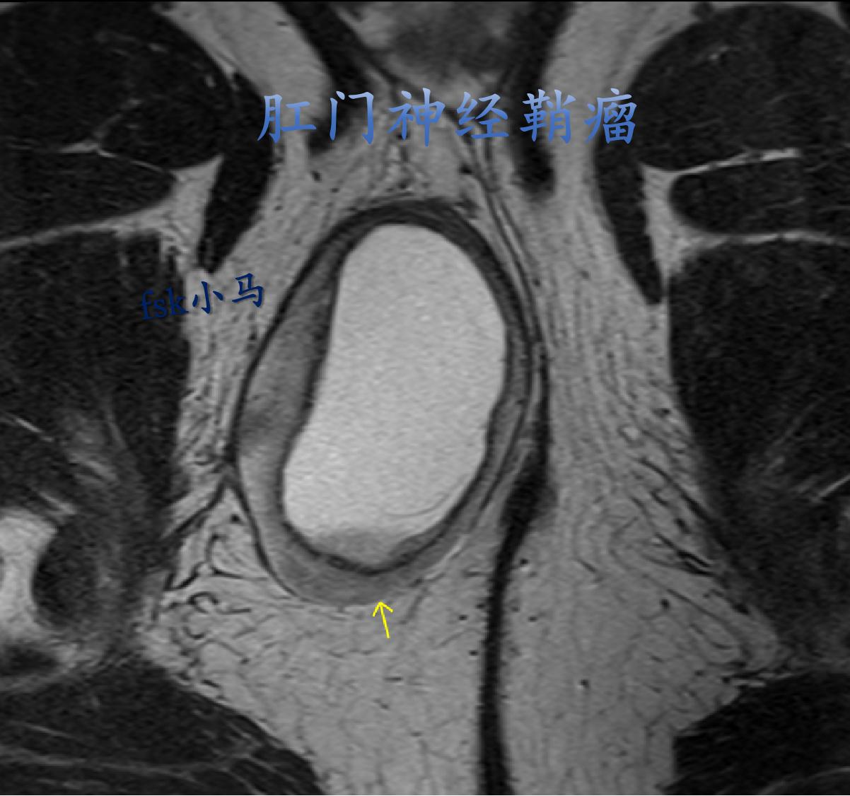 肛门神经鞘瘤