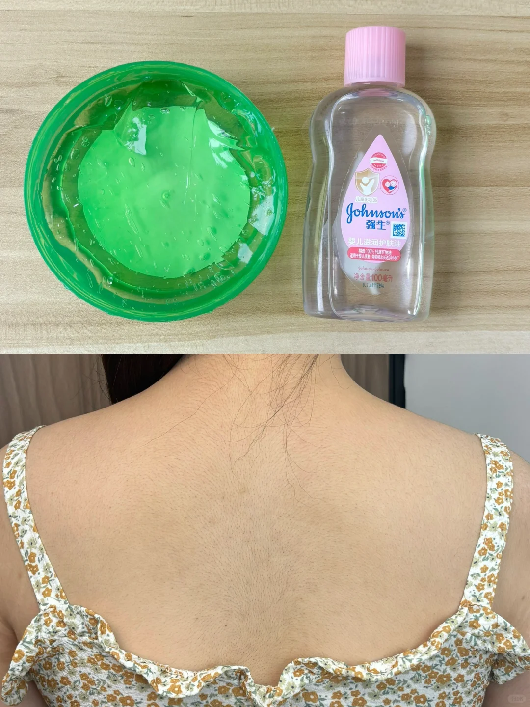 因为后背长痘被拉去看了……