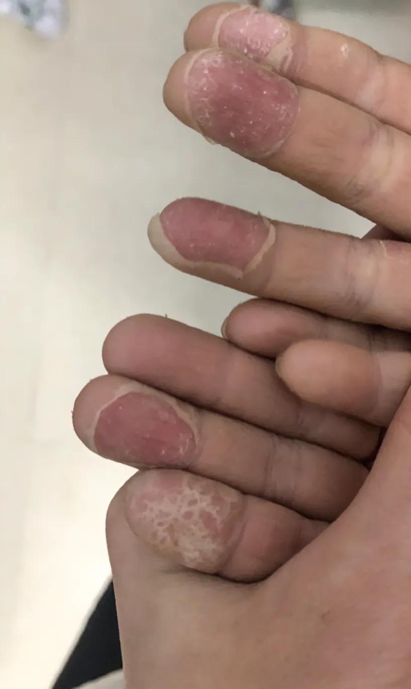 孩子手这样是什么原因#儿科小知识分享# #孩子积食那些事# #育儿经脸分享# #