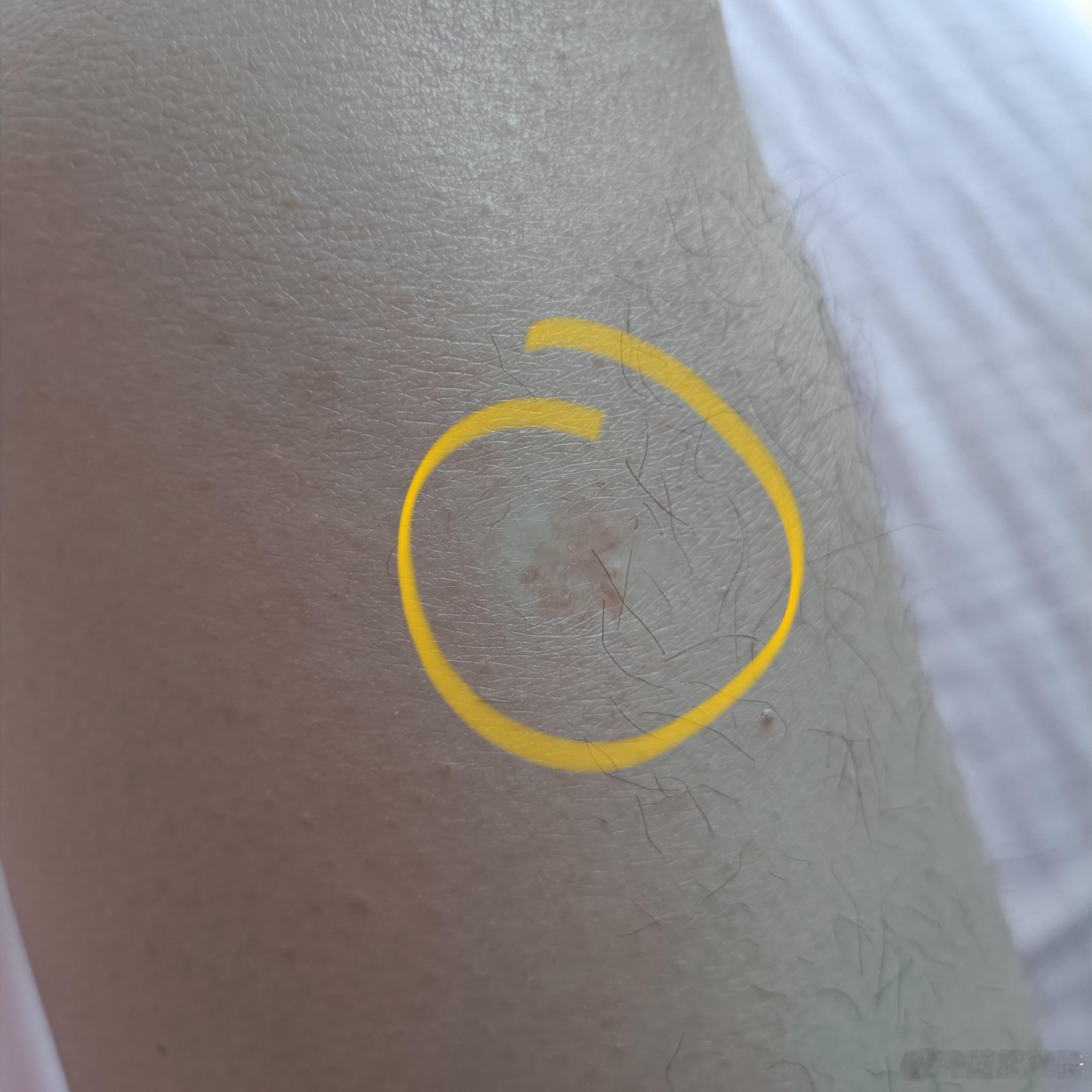 #男孩骑车失误刹车把手插进大腿里#，一大早看到热棒第一的事情居然跟我自己孩时的遭