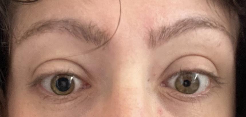 偏头痛发作时，有人瞳孔会一大一小。