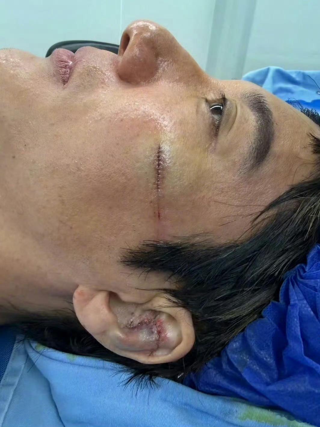 王力宏缝了39针刷微博才知道这么严重坚持唱完去缝了这么多针想想得多疼吧向王力宏致