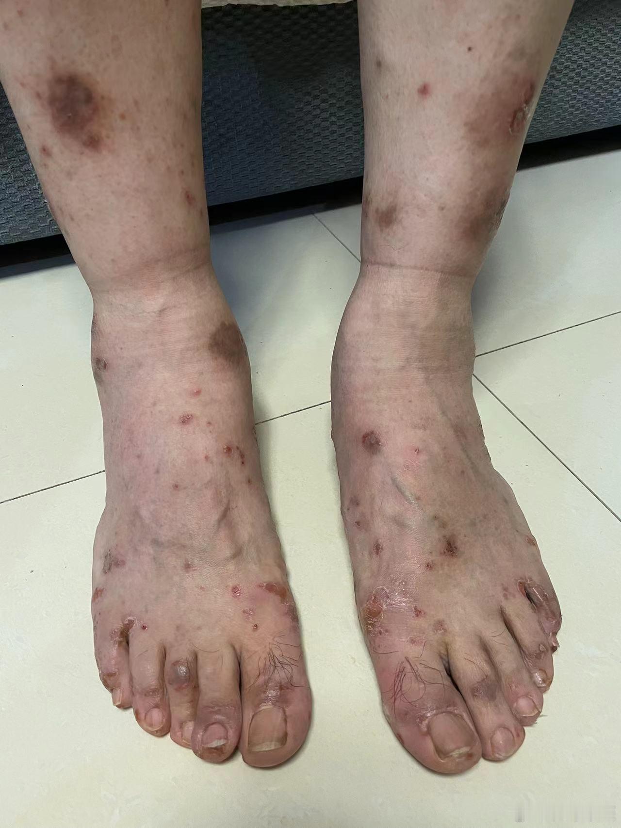 看久治不愈的皮肤病，越来越有信心了。记得以前也聊过关于治疗皮肤病的话题，但这个案