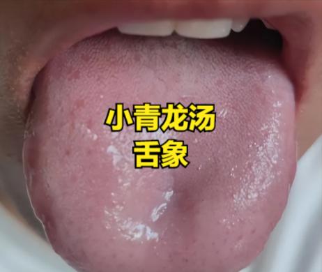 分享五个超猛祛湿药，帮你吸干一身湿气
1. 湿气停留在肺里
表现：嗓子有痰，而且