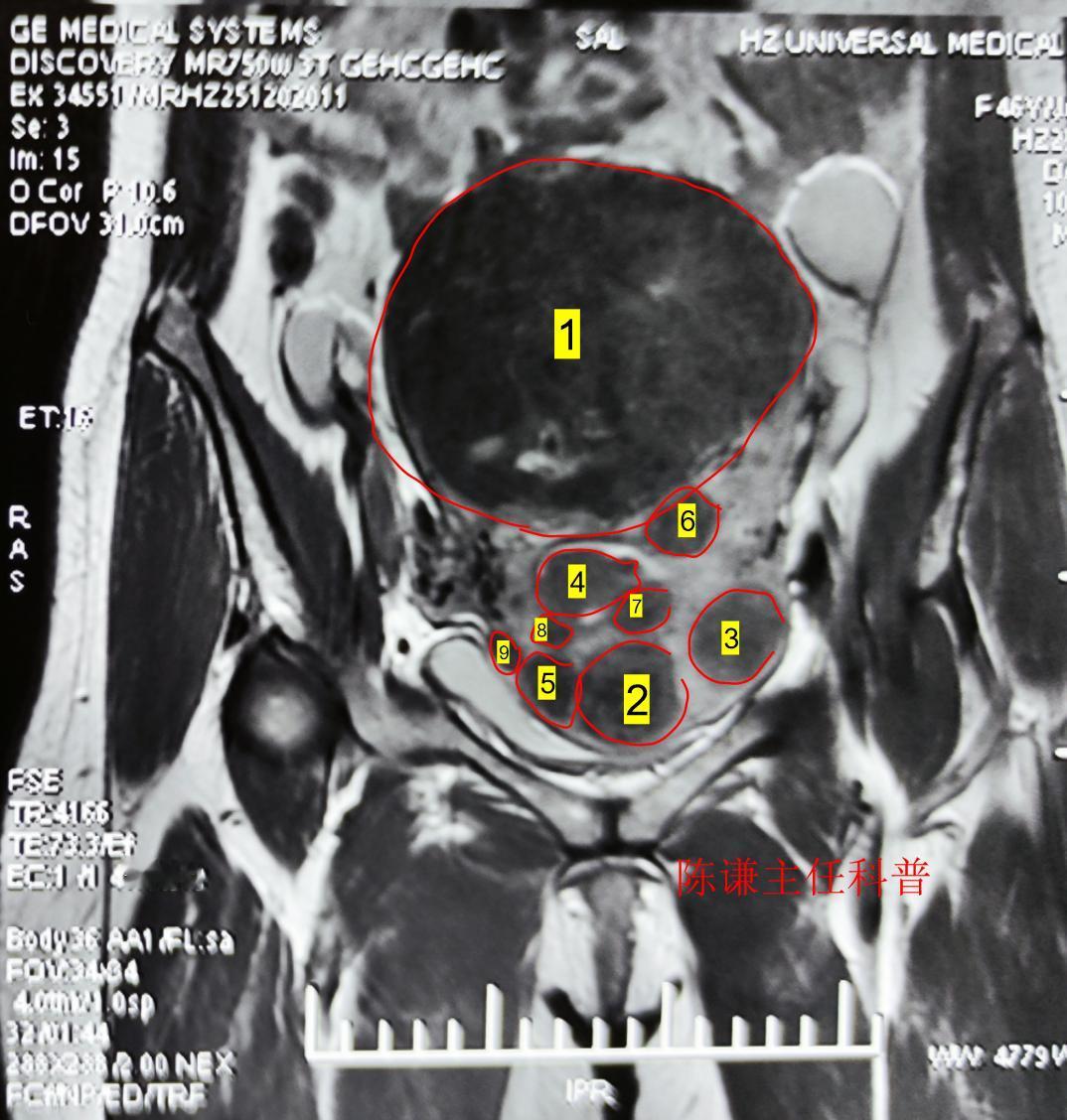 这是我们才治疗的一名多发性子宫肌瘤患者，患者来自上海，发现肌瘤有近10年了，患者