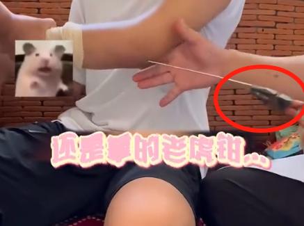 原来，骨折的时候打进身体里的钢针，是这么取出来的，拿个钳子就往外生拔，我吃烧烤的