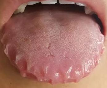 湿在心——胸闷、心悸；湿在肺——咳嗽、吐痰；湿在肾——怕冷、手脚肿；湿在脾——身