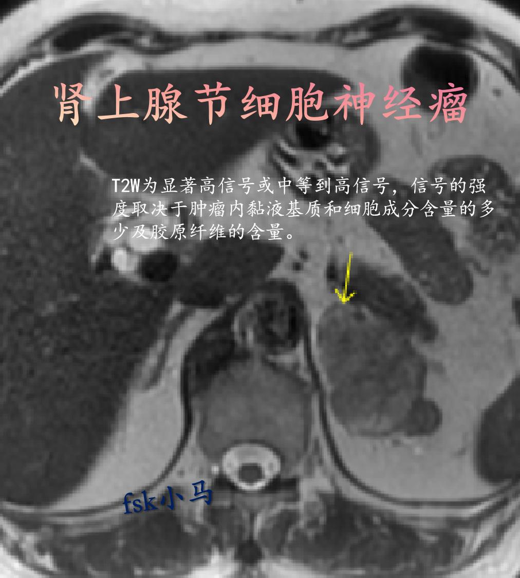 肾上腺节细胞神经瘤