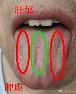 舌诊实战分享：
病人主诉：阴囊潮湿、心情易燥易怒、男科不好 
肝胆湿热—舌边发红