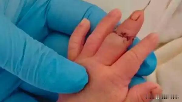 1月5日，盱眙县卫生健康委员会就一起新生儿在剪脐带过程中手指被剪断的事件发布了情