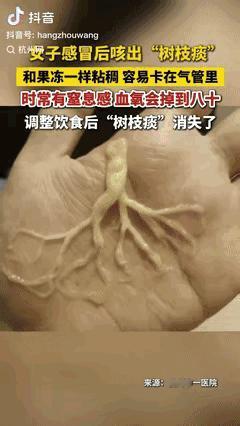 真吓人！杭州，女子得了病毒性感冒后，咳嗽非常厉害，可她觉得没必要看医生，硬是抗了