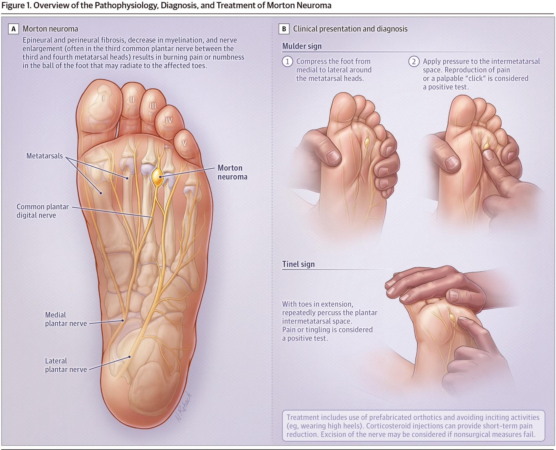 2023JAMA 综述。足踝部疼痛的3种常见疾病：莫顿神经瘤（跖间神经...
