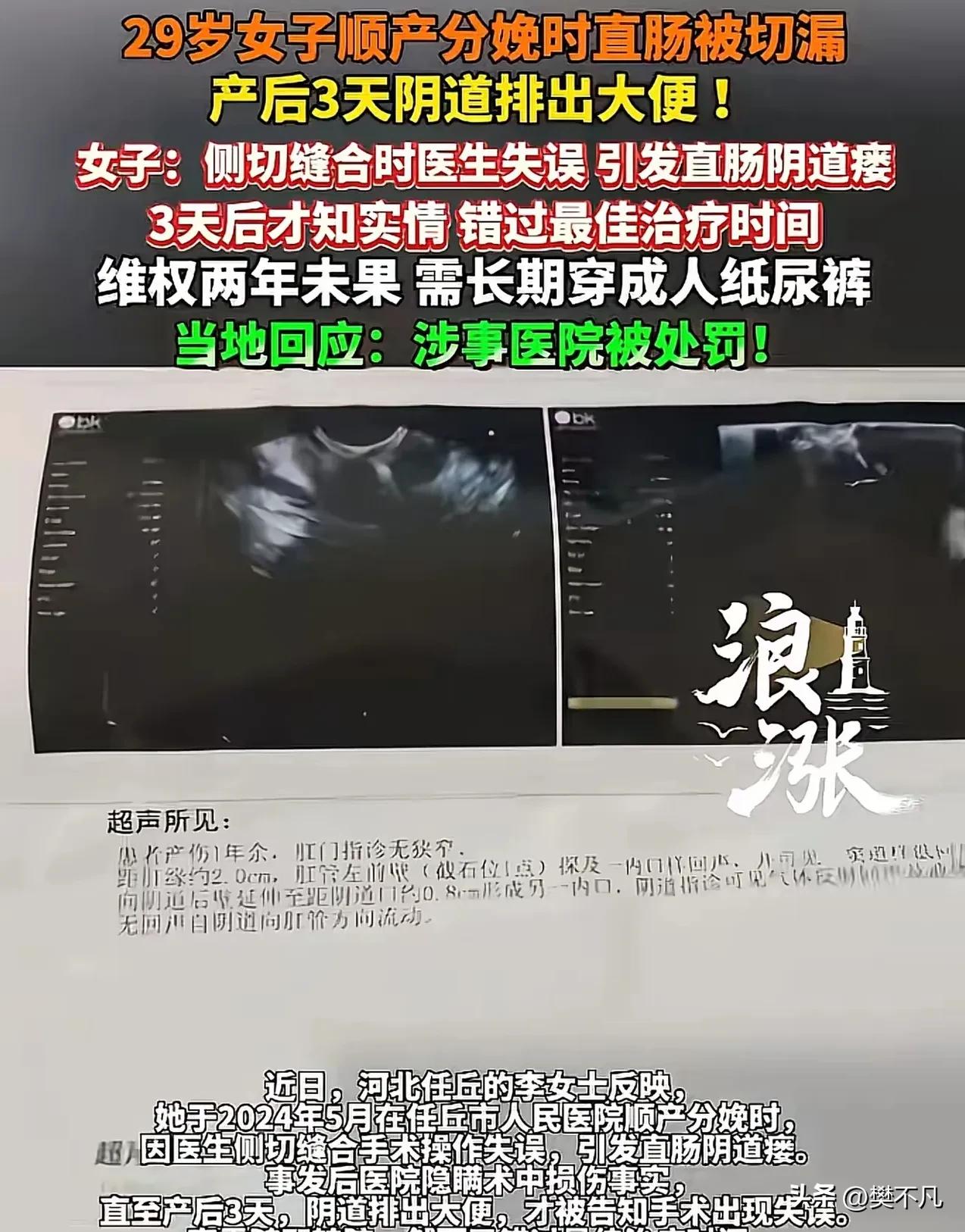 29岁妈妈生完孩子，三天后阴道排出大便，医生才说：侧切时把你的直肠切漏了

河北