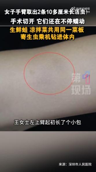 “太吓人了！”6月15日光明网报道，广东深圳，一女子一年前手臂上莫名其妙长了包块