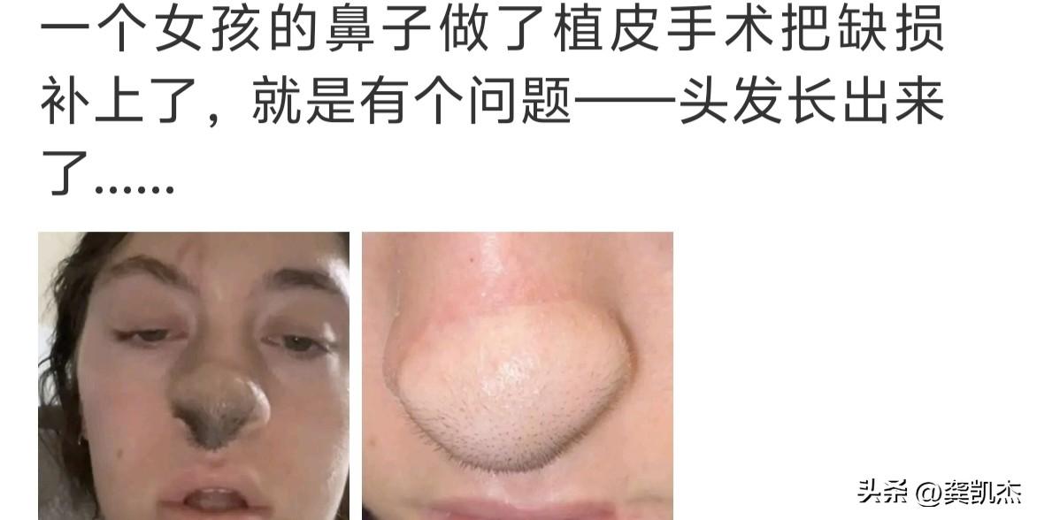 鼻子植皮手术结果头发长出来了，你说怎么办？