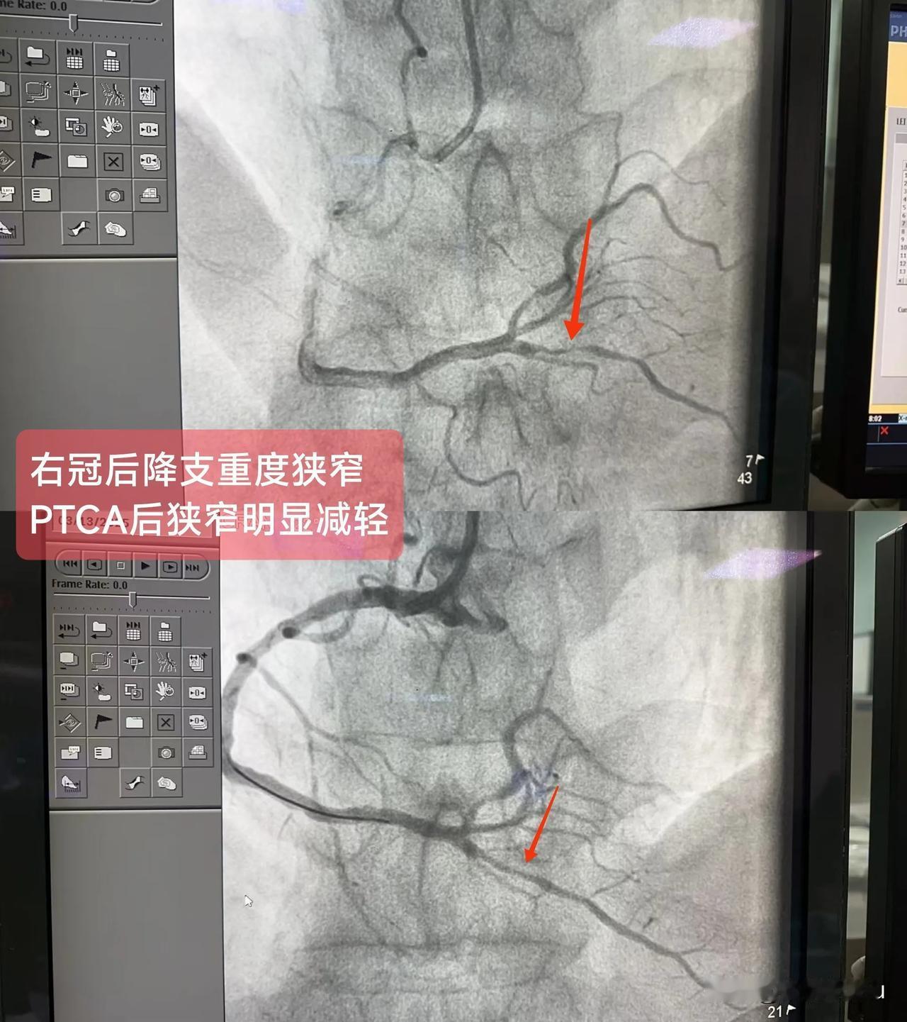 急性非ST段抬高型心肌梗死
（右冠后降支重度狭窄）
概念：右冠状动脉起自右冠窦，