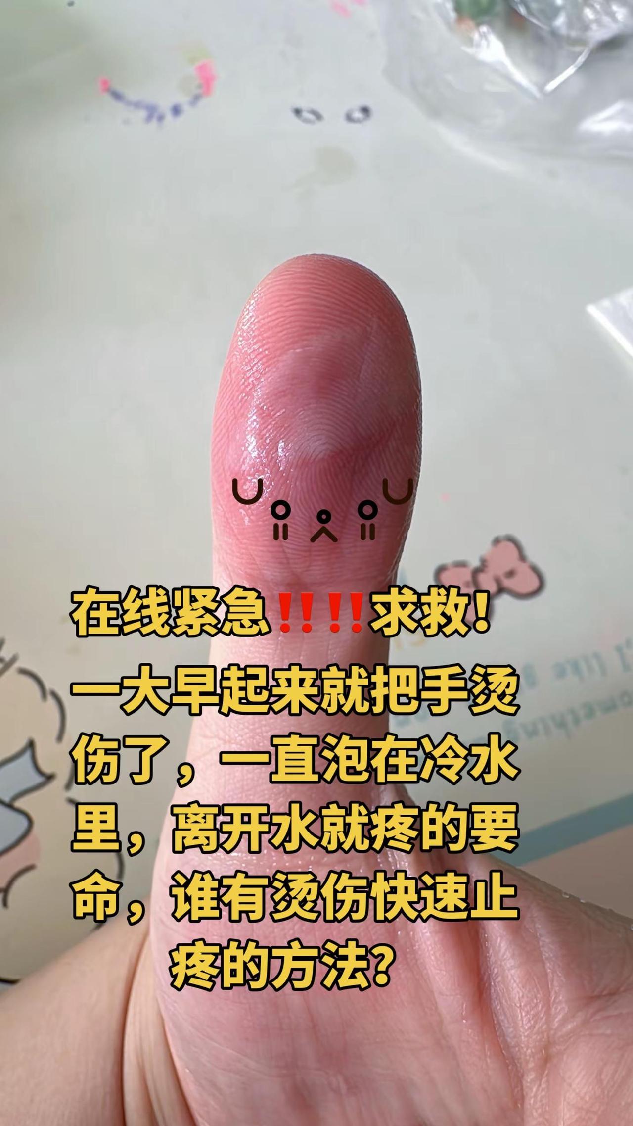 手指喜提一级烫伤，这下干啥都得单手操作了，我这笨手笨脚的，把自己都整笑了烫伤怎么