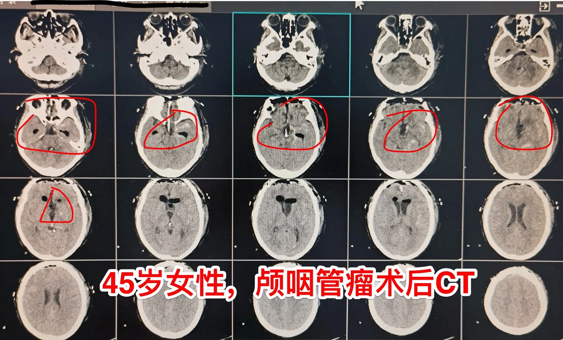 巨大的颅咽管瘤。45岁浙江女性，在外院作了颅咽管瘤手术不到一年，作磁共...