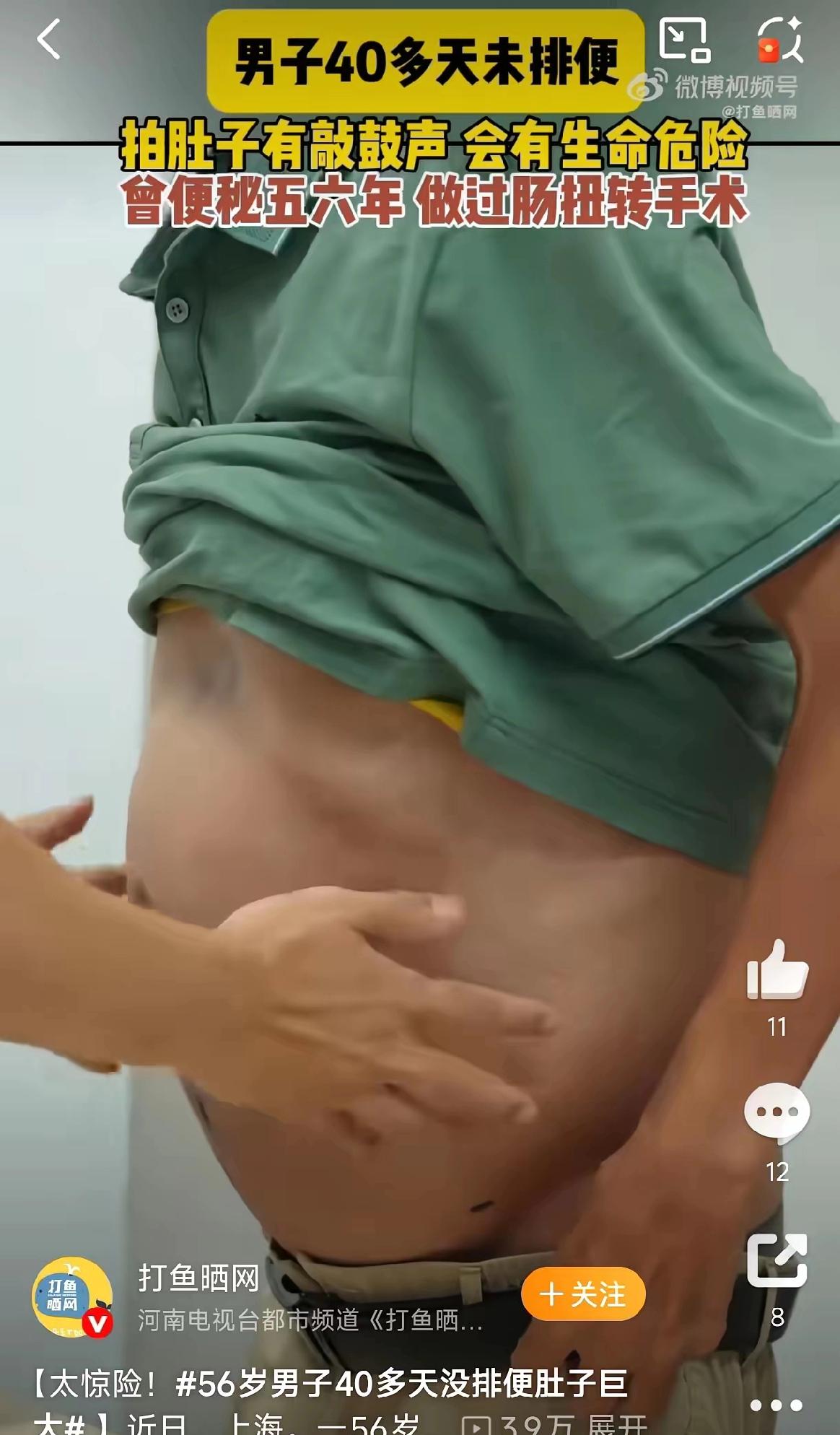 心太大！上海，一56岁男子，他硬生生40天没排便，肚子鼓得像块硬石头，裤子根本扣